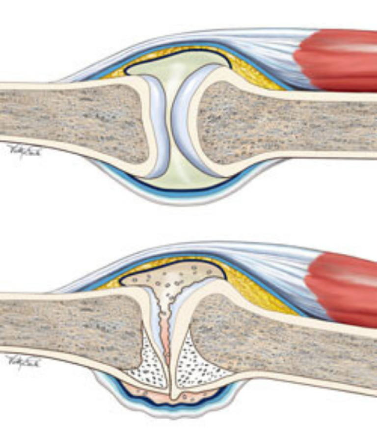 joints osteoarthritis