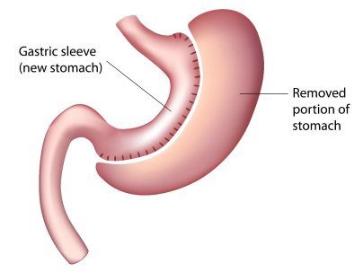 Illustration of the Laparoscopic VSG procedure